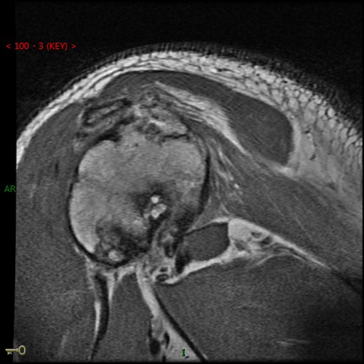 Figure 4 for case Chronic posterior glenohumeral dislocation ( RID4770 )